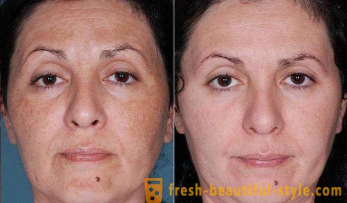 Kulit asid untuk muka: ulasan, gambar sebelum dan selepas
