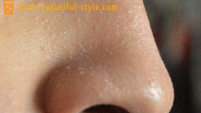 Mengapa kulit bersisik pada muka? kulit muka masalah