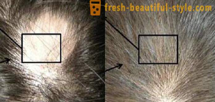Mesoterapi untuk rambut: Alat Solek dan kontra